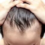 تساقط الشعر - الصلع عند الرجال