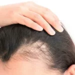 تساقط الشعر - ثعلبة الجر Traction alopecia